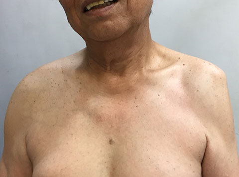 脱臼の施術